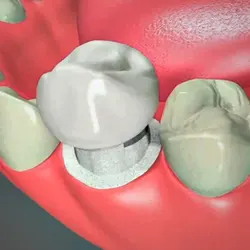 Dental Crowns Dental Crowns