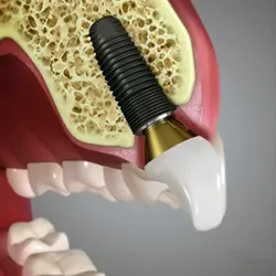 Dental Implants Dental Implants