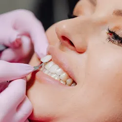 Dental Veneers Dental Veneers