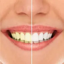 Teeth Whitening Teeth Whitening